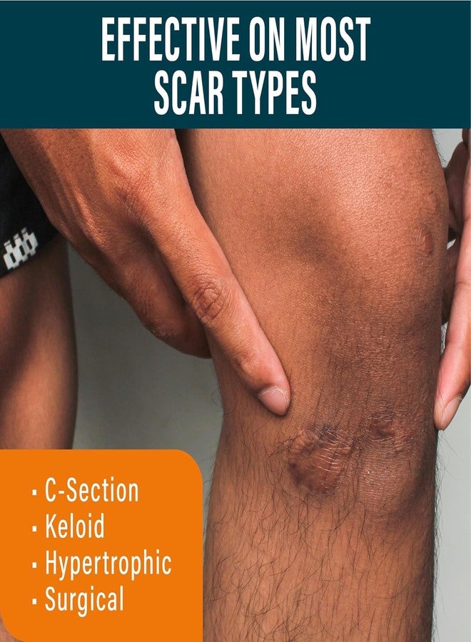 نوفاديرميس صفائح ندبات سيليكون طويلة جدًا من نوفاديرميس مع جل للندبات - صفائح طبية قابلة لإعادة الاستخدام للندبات الناتجة عن الولادة القيصرية، وشد البطن، والندبات الجدرية، والندبات الجراحية - Image 3